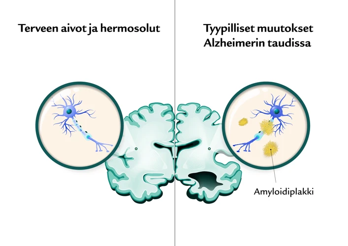 Alzheimerin Tauti